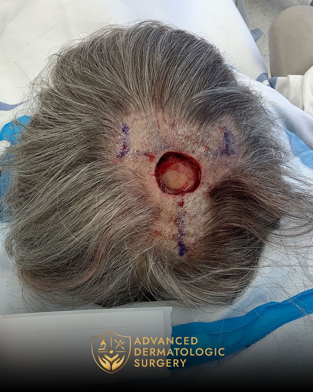 Mohs surgery on scalp at Advanced Dermatologic Surgery.
