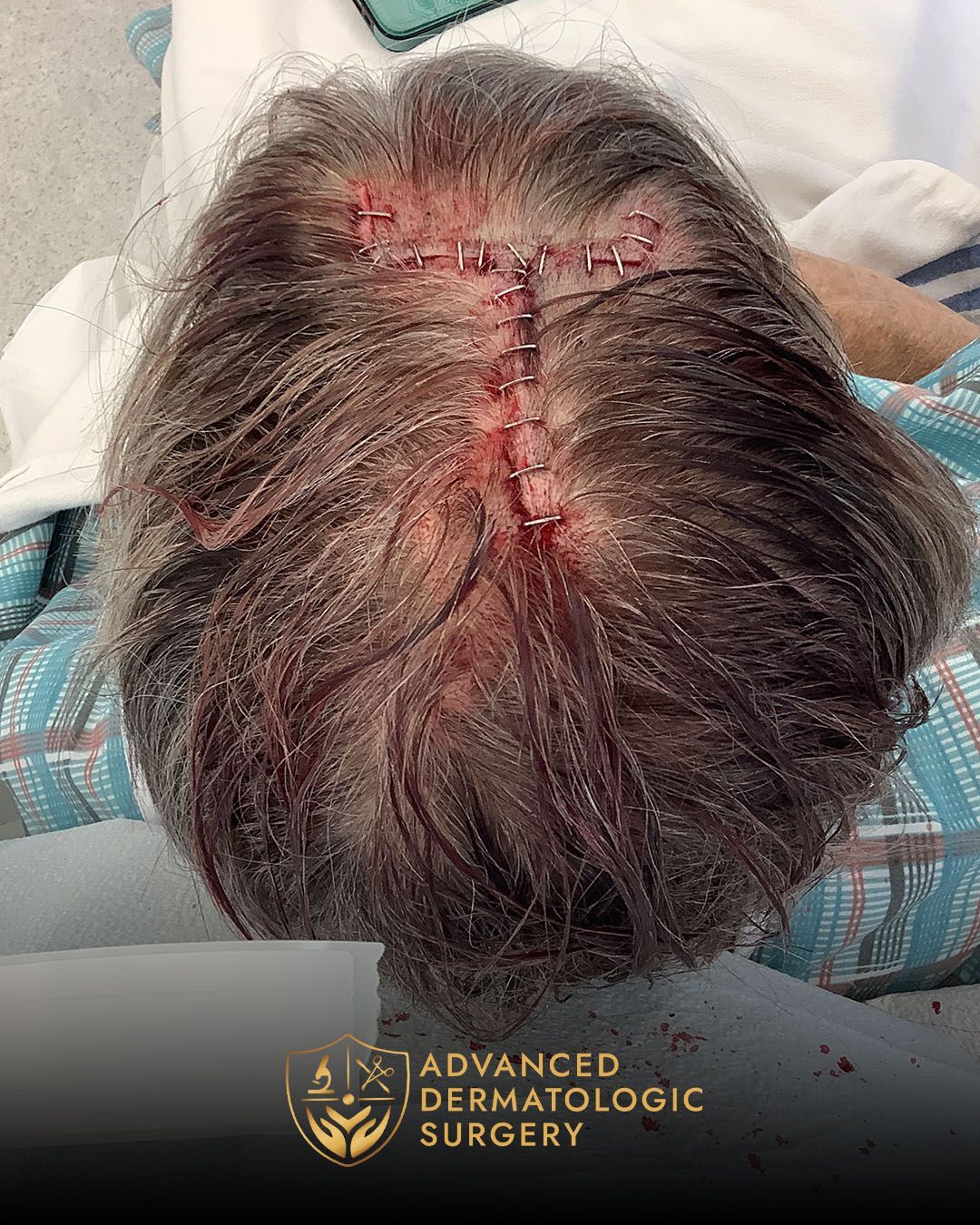 Reconstruction after Mohs surgery on scalp at Advanced Dermatologic Surgery
