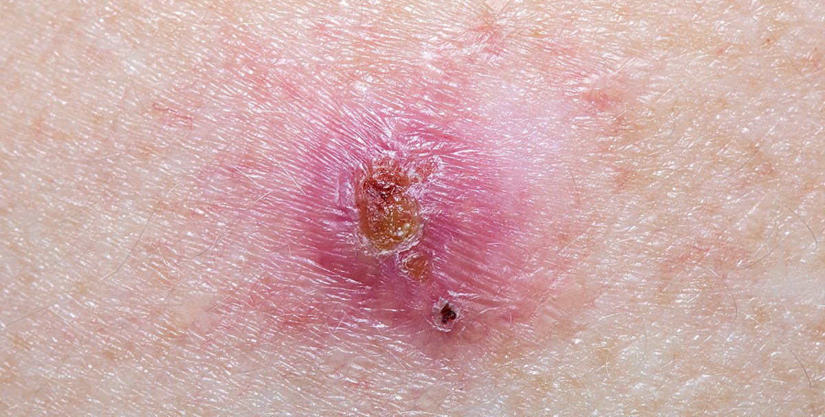 A close up of a basal cell carcinoma on person's skin at Advanced Dermatologic Surgery in Overland Park, KS