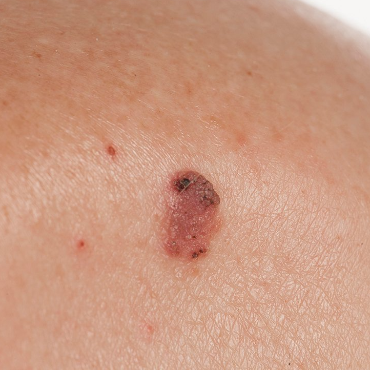 A close up of a Squamous Cell Carcinoma cancerous mole on a person 's skin.