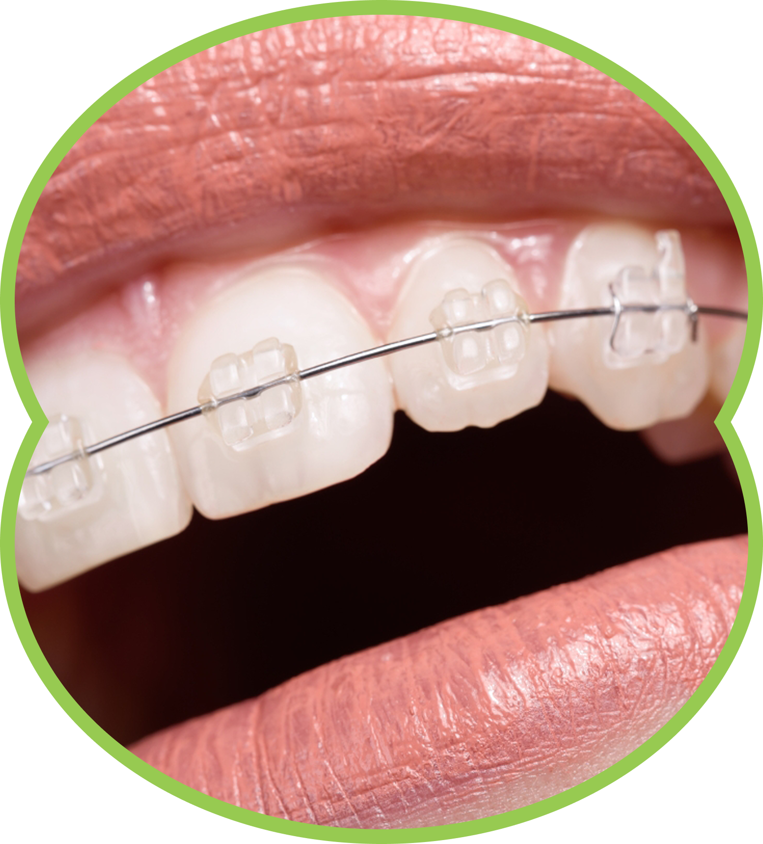Close-up of teeth with clear braces and a metal orthodontic wire on a smiling mouth
