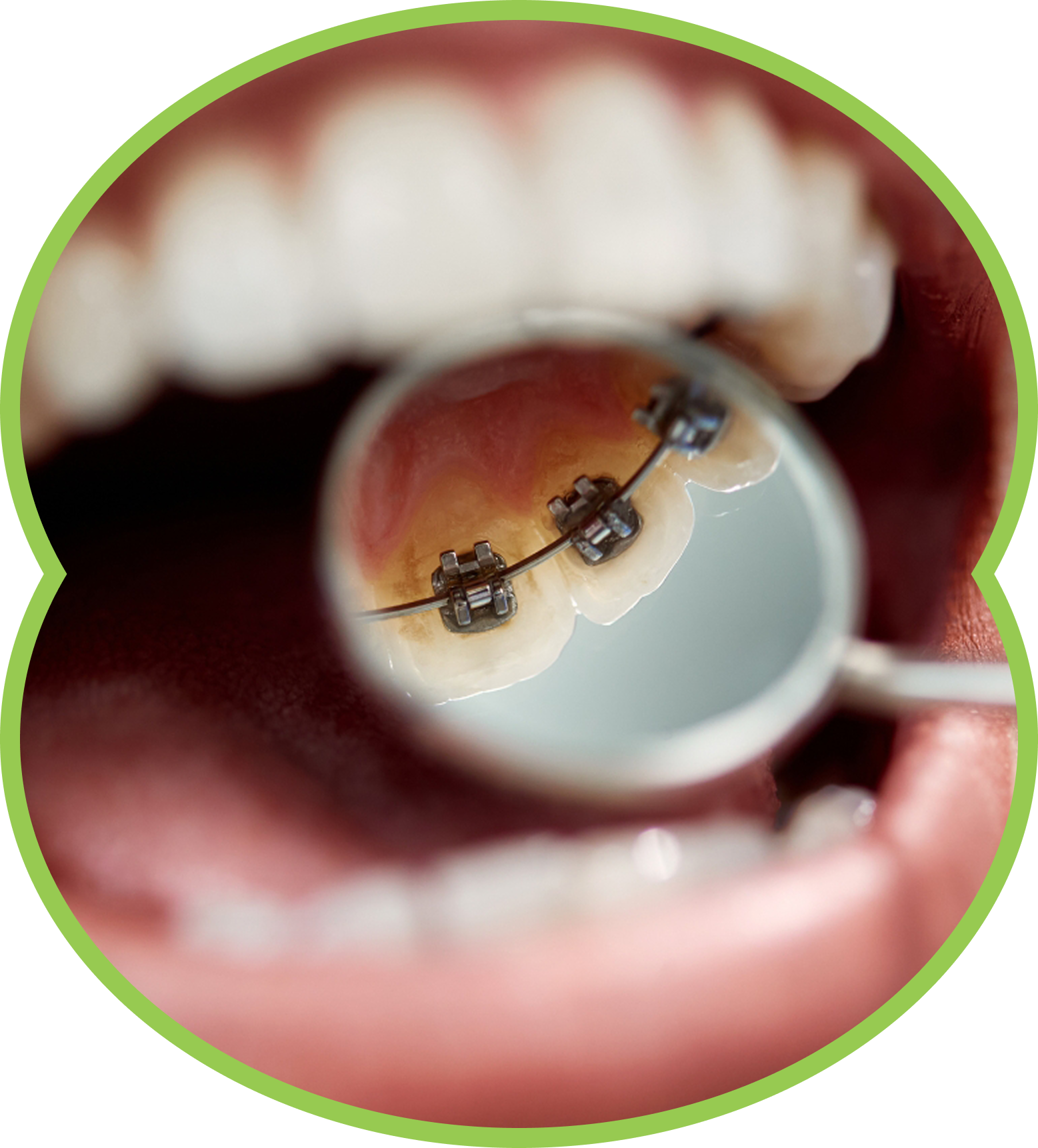 Close-up of teeth with braces, viewed through a dental mirror inside an open mouth.