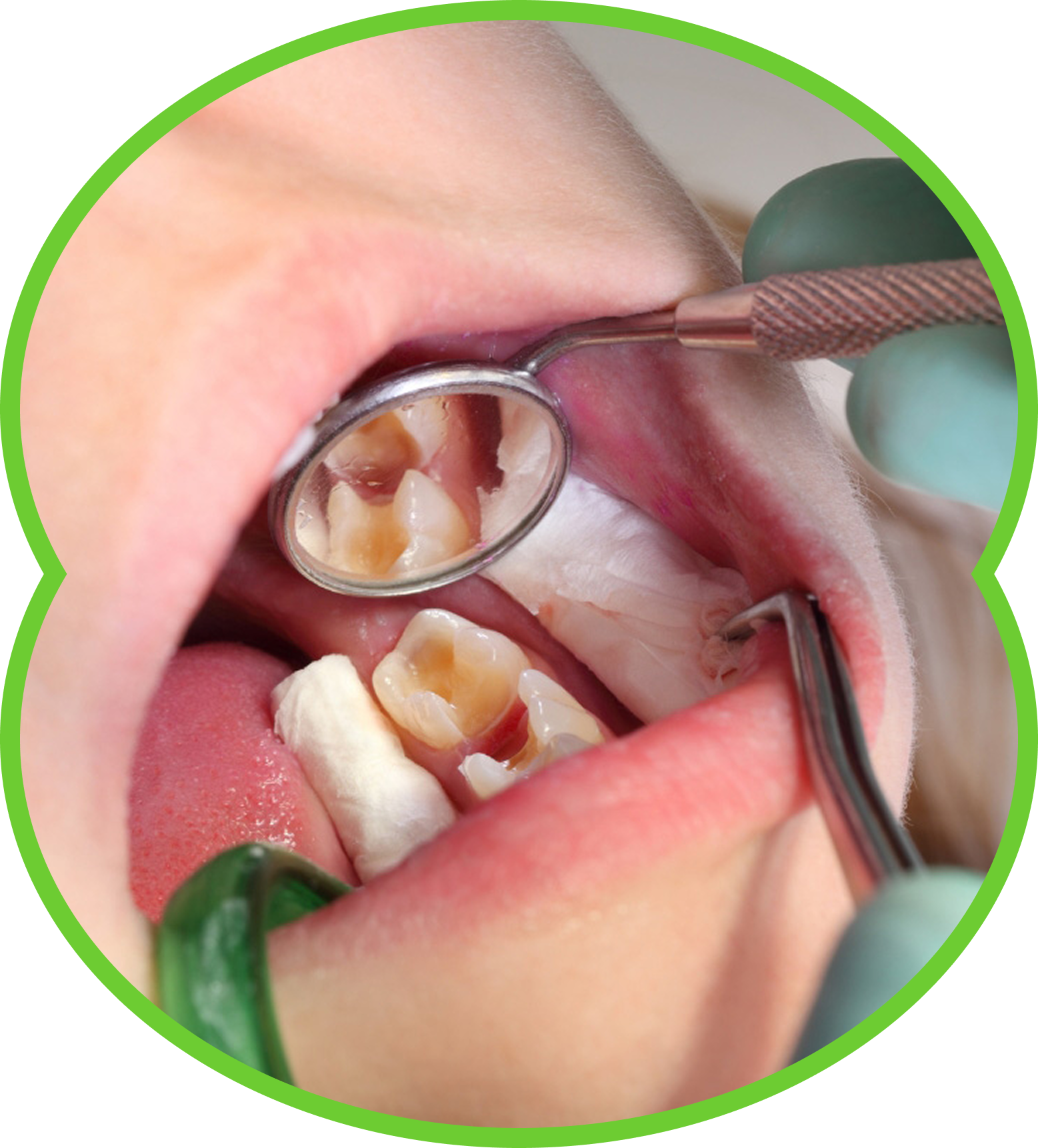 Dental mirror showing a child’s teeth with cavities during a dental exam