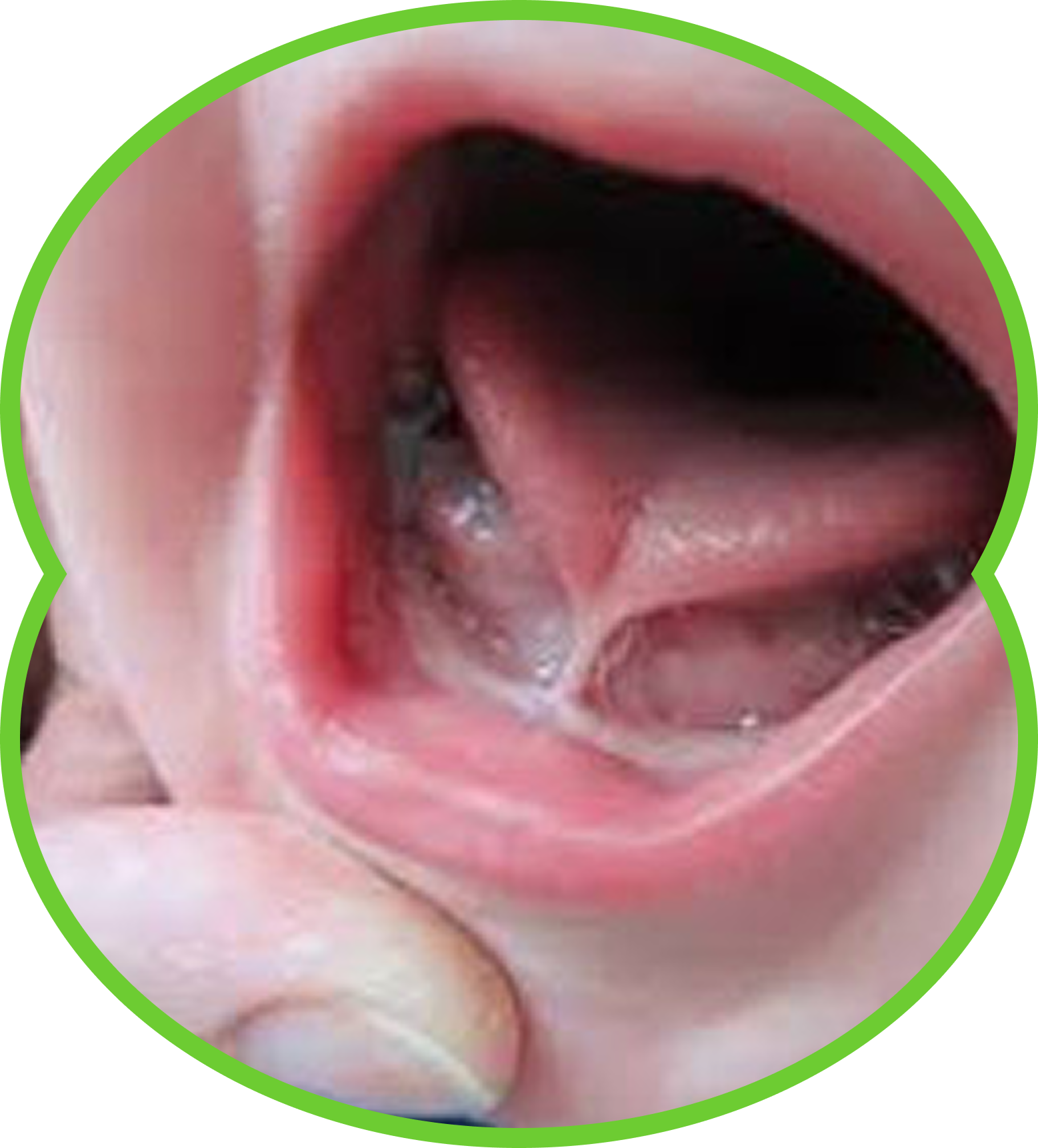 Close-up of a baby’s open mouth with a visible tongue and gums, framed by a green circle.