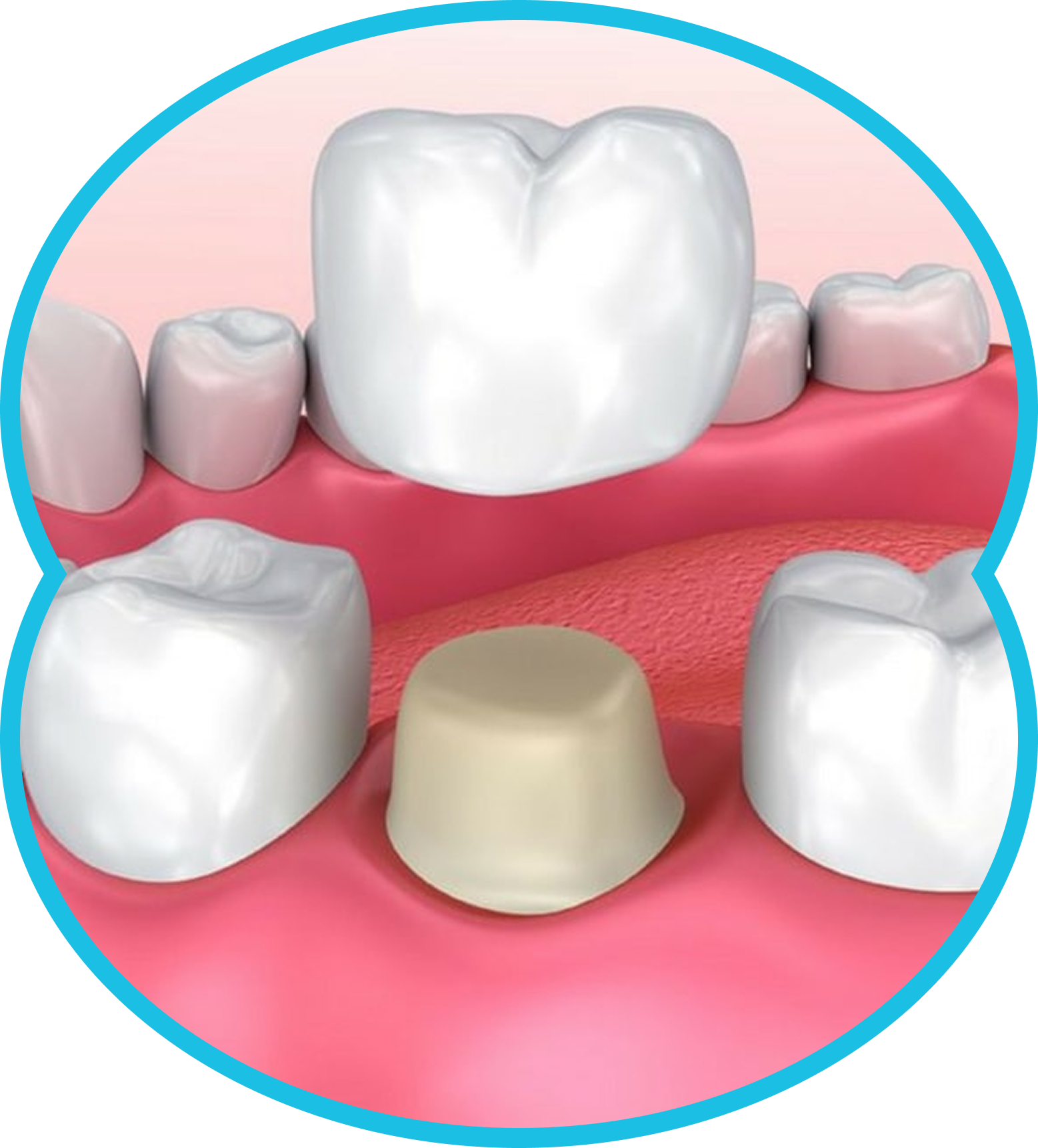 Dental implant model showing a beige implant post surrounded by white teeth and pink gums