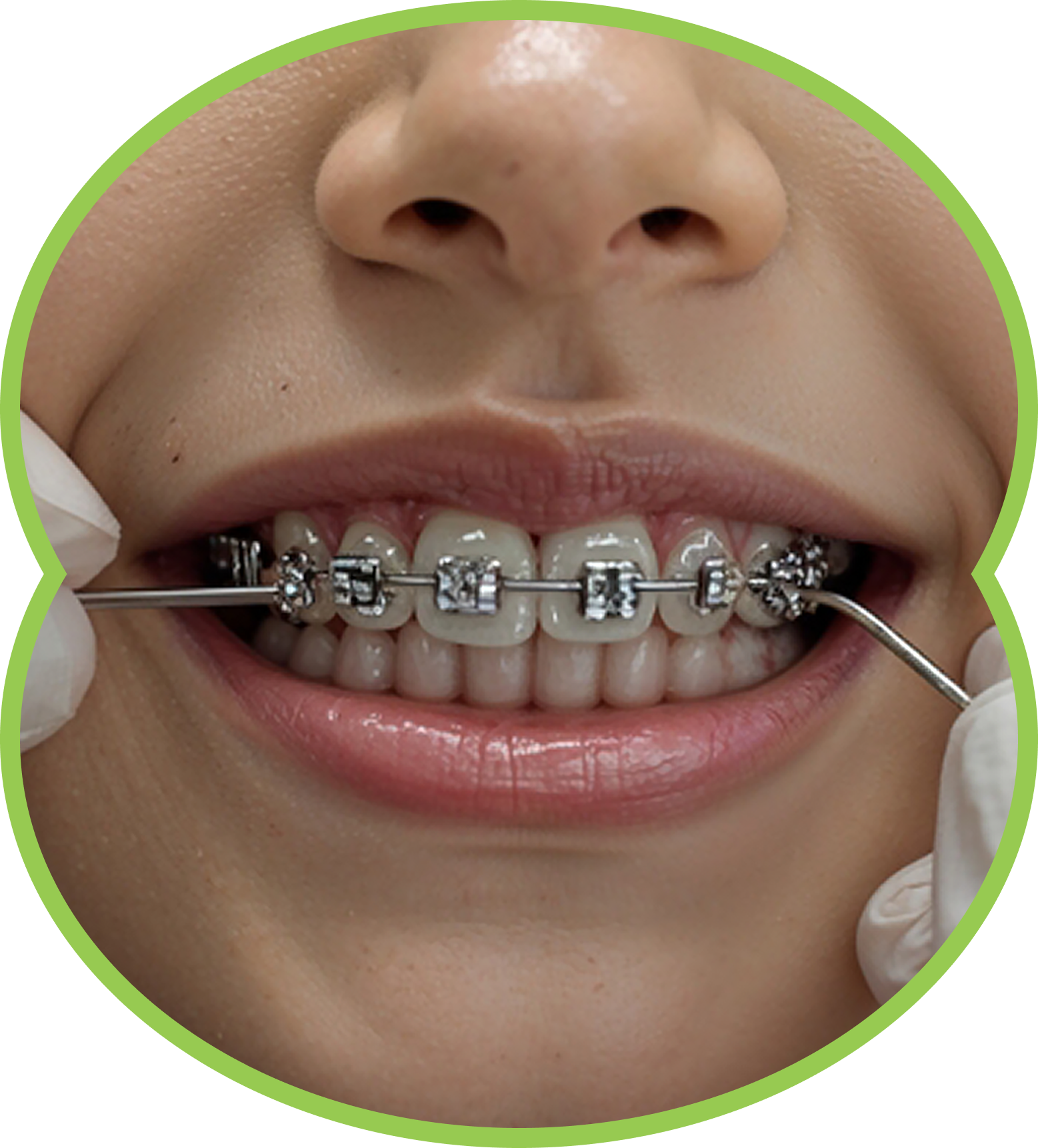 Close-up of a smiling mouth with metal braces being adjusted by gloved hands