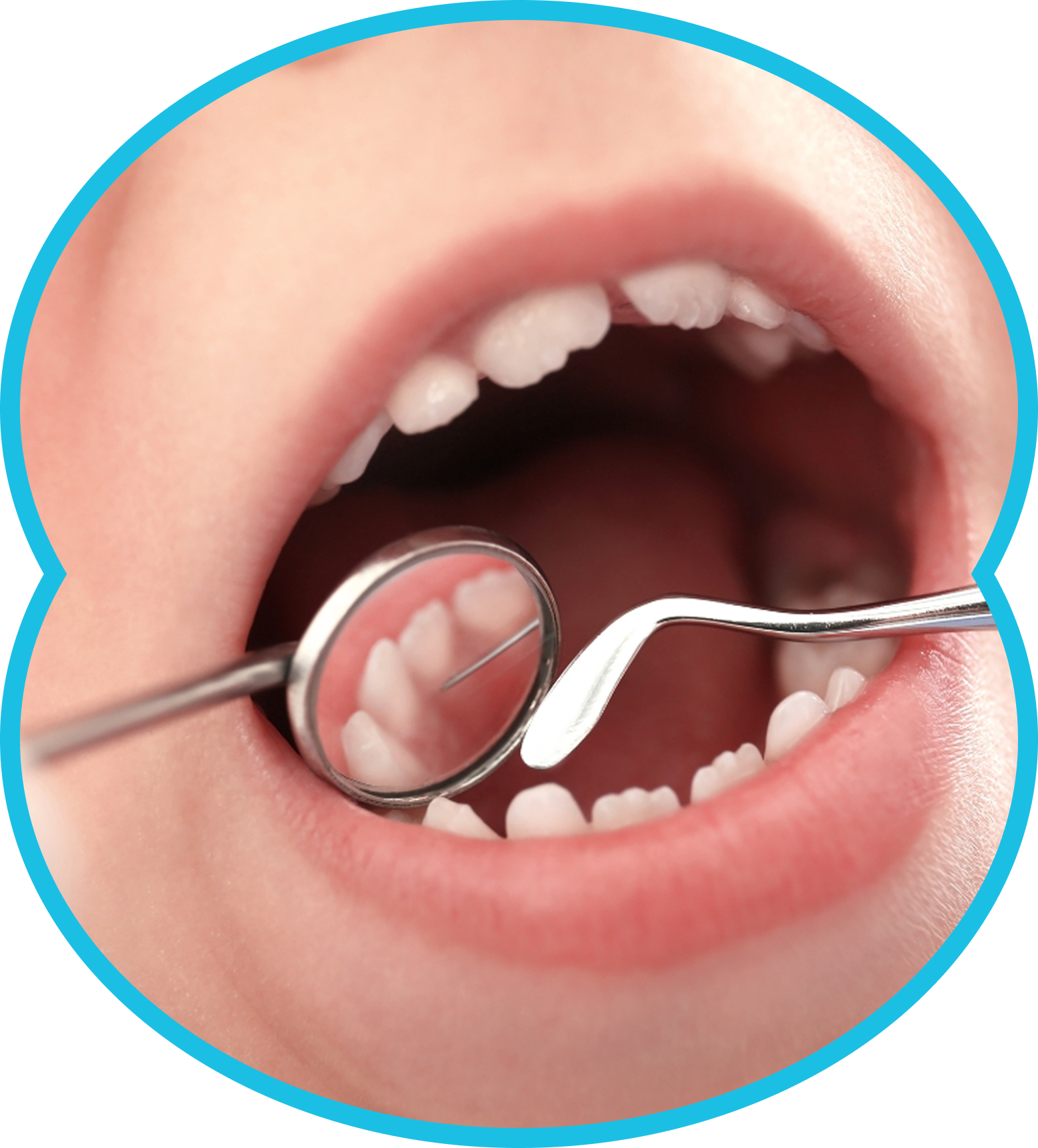 Mouth open during dental exam, with mirror and dental tool reflecting teeth.