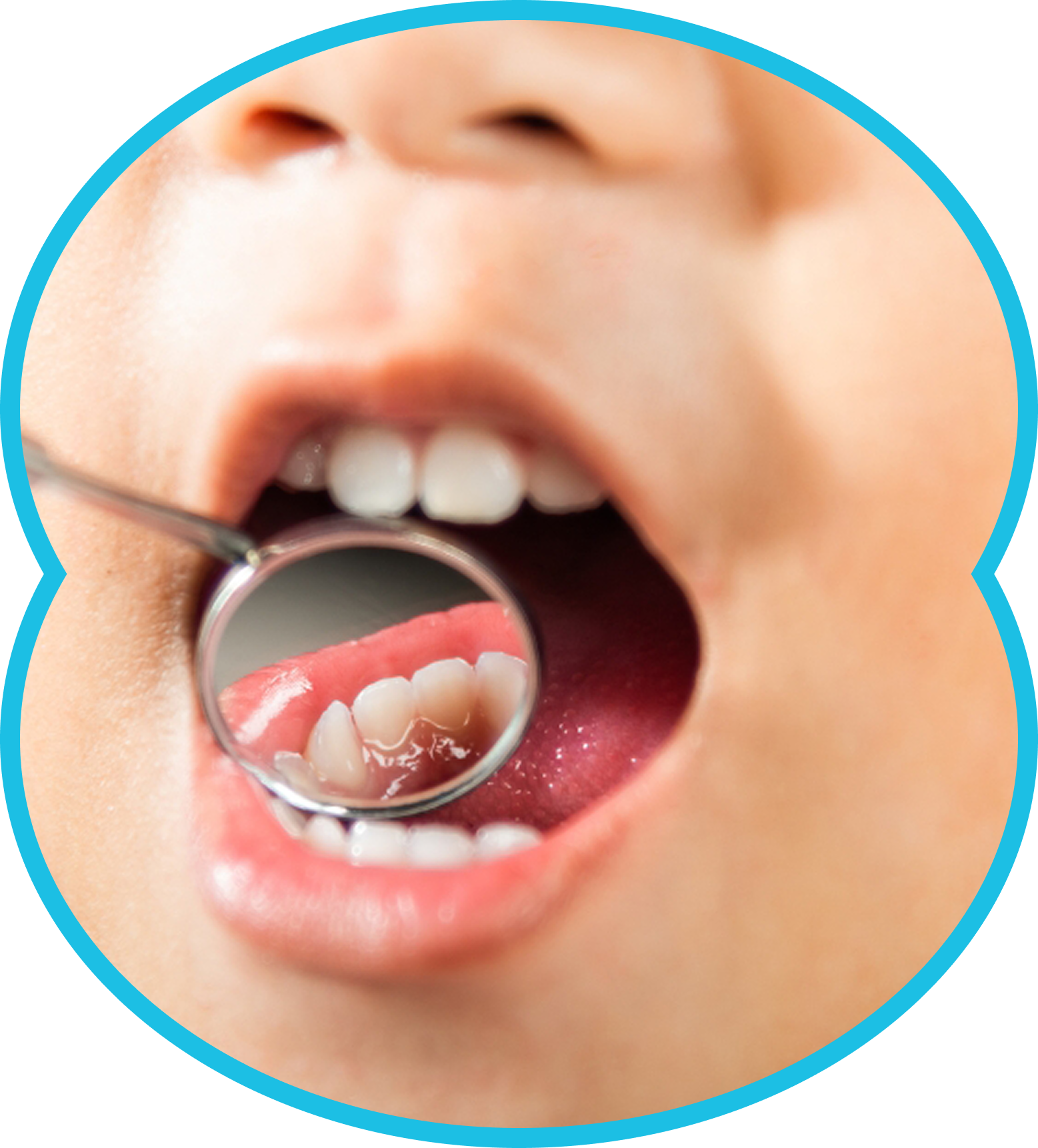 Close-up of a child's open mouth showing teeth being examined with a dental mirror