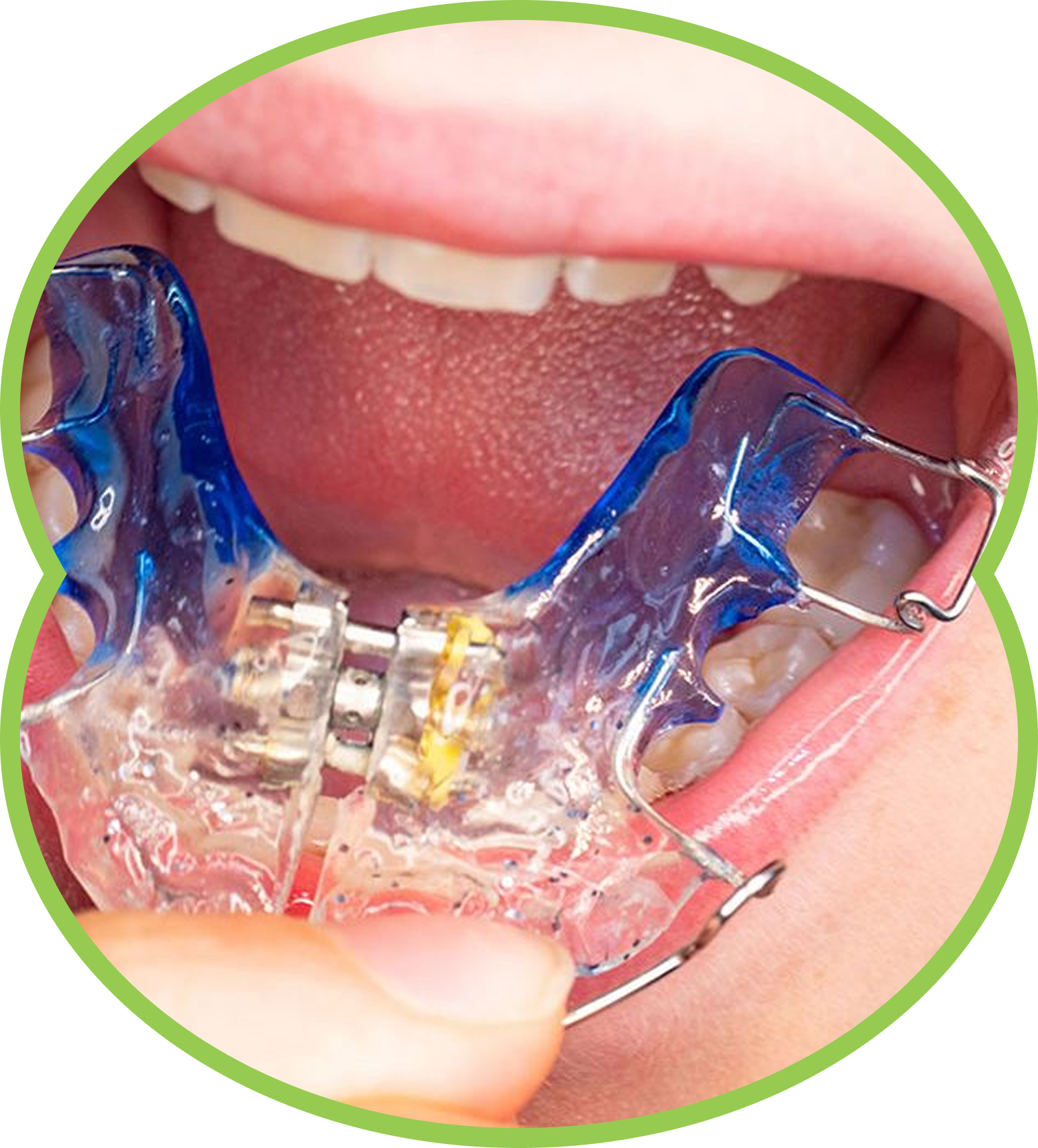 Mouth with a clear and blue orthodontic appliance fitted across the lower teeth