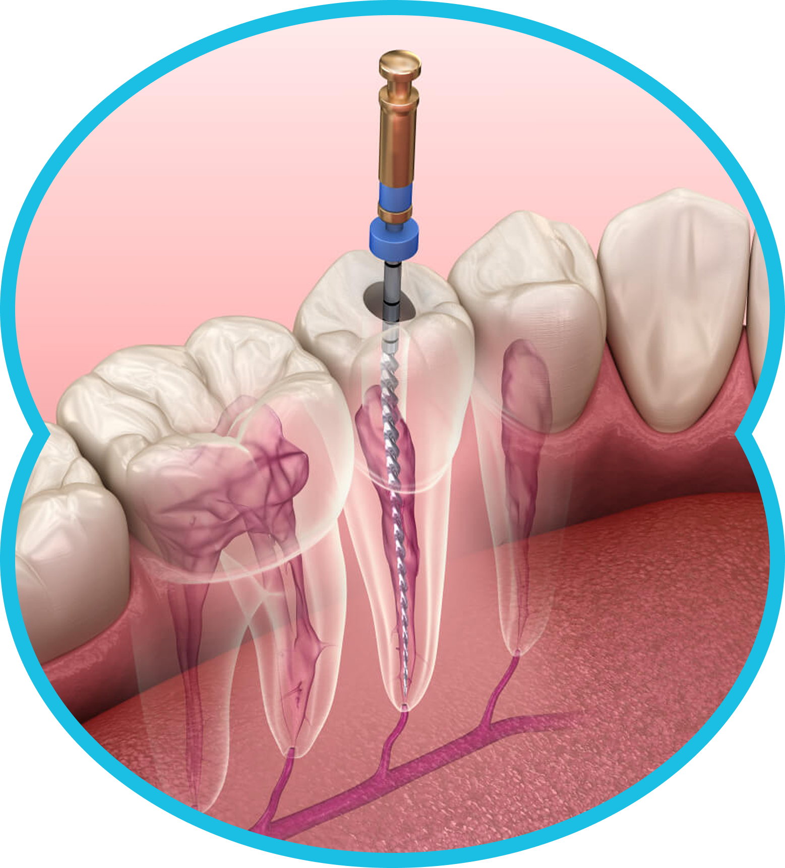 Dental root canal treatment on a molar with a drill and exposed tooth root illustration