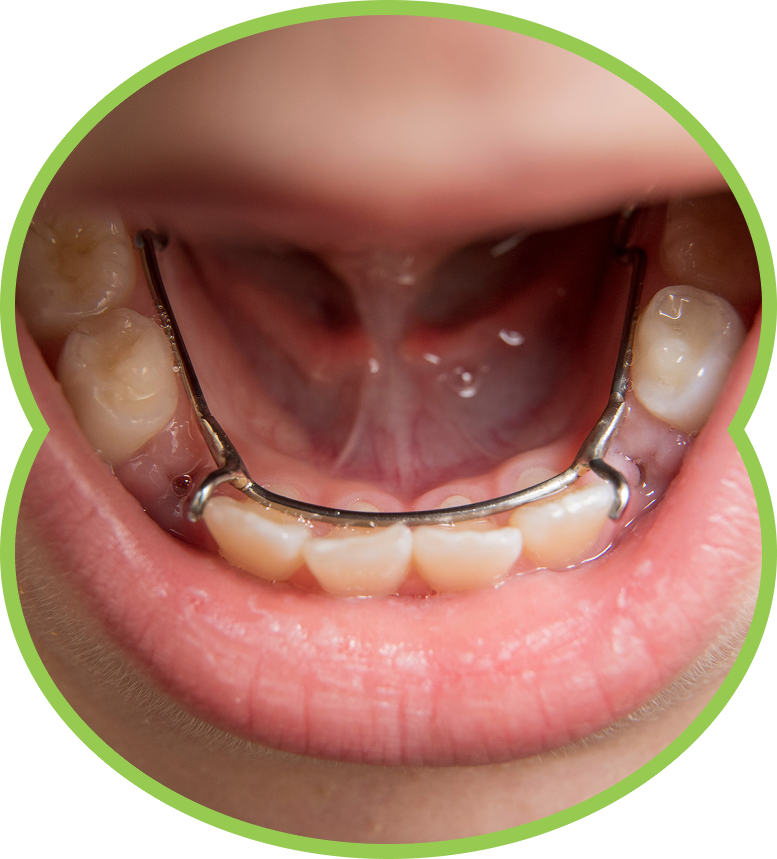 Close-up of mouth with lower metal retainer and teeth visible inside a green circular frame