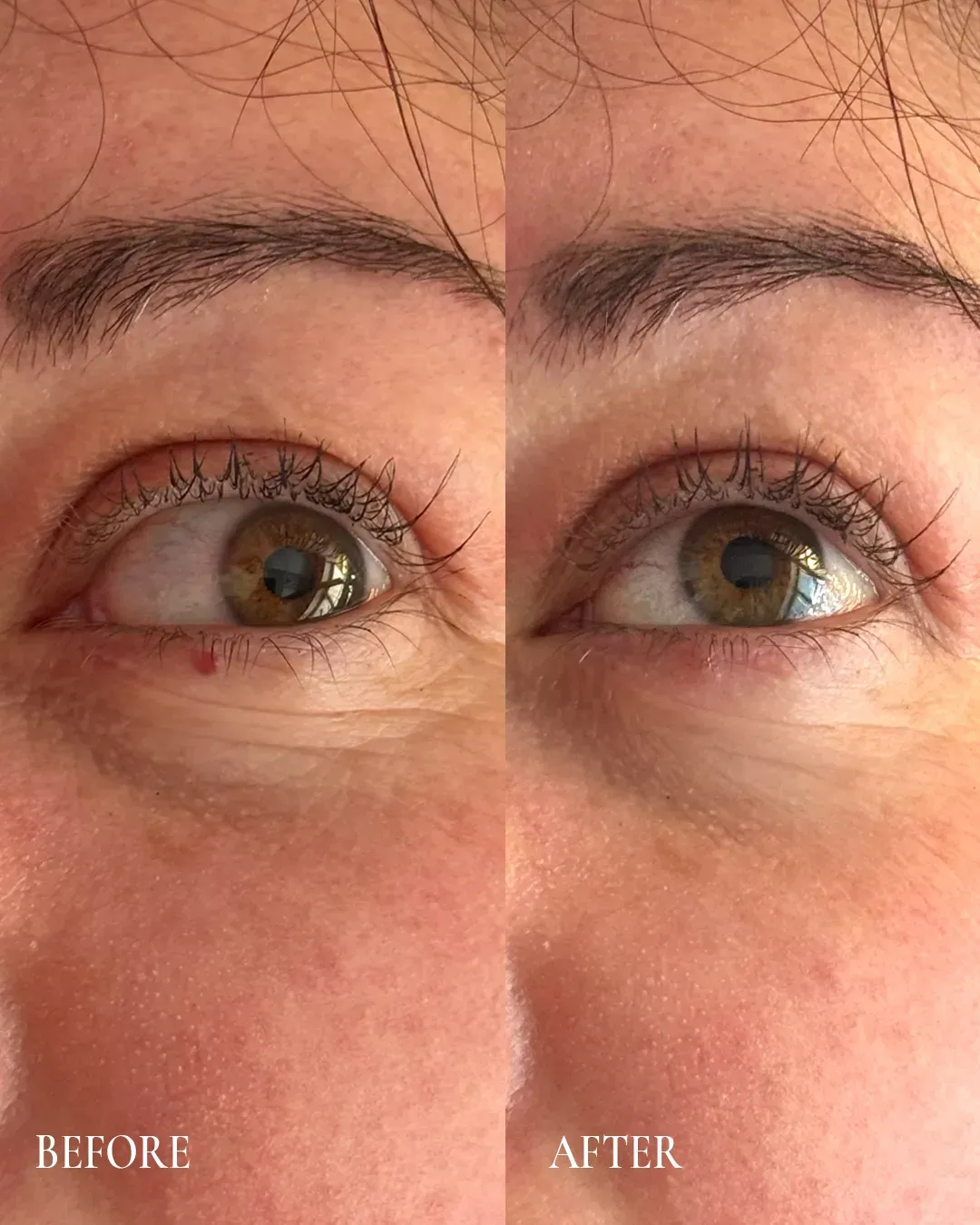Side-by-side close-up of an eye before and after, showing reduced redness in the after image.