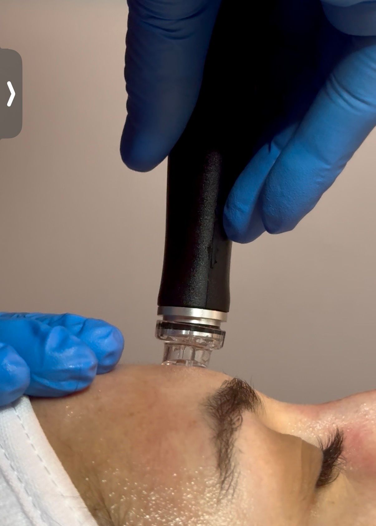 Gloved hands use a facial treatment device near a person’s closed eye and forehead.