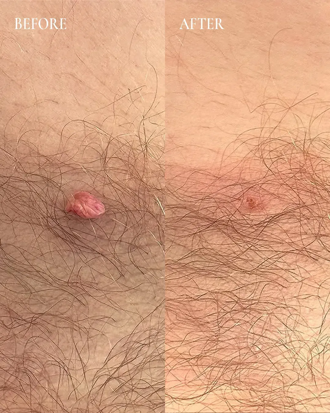Before-and-after close-up of skin with a pink bump removed, showing a smoother area on the right.