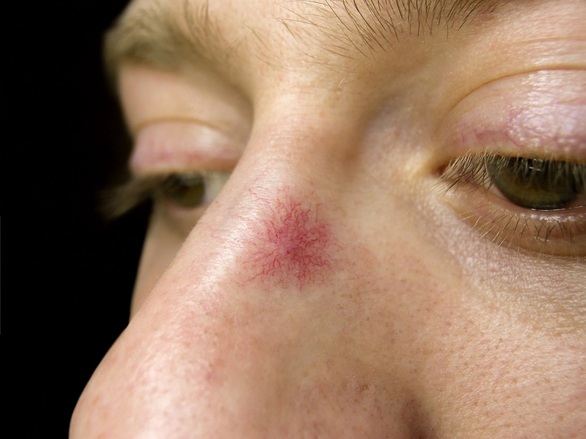 Close-up of a bruised nose bridge on a face, showing redness and swelling