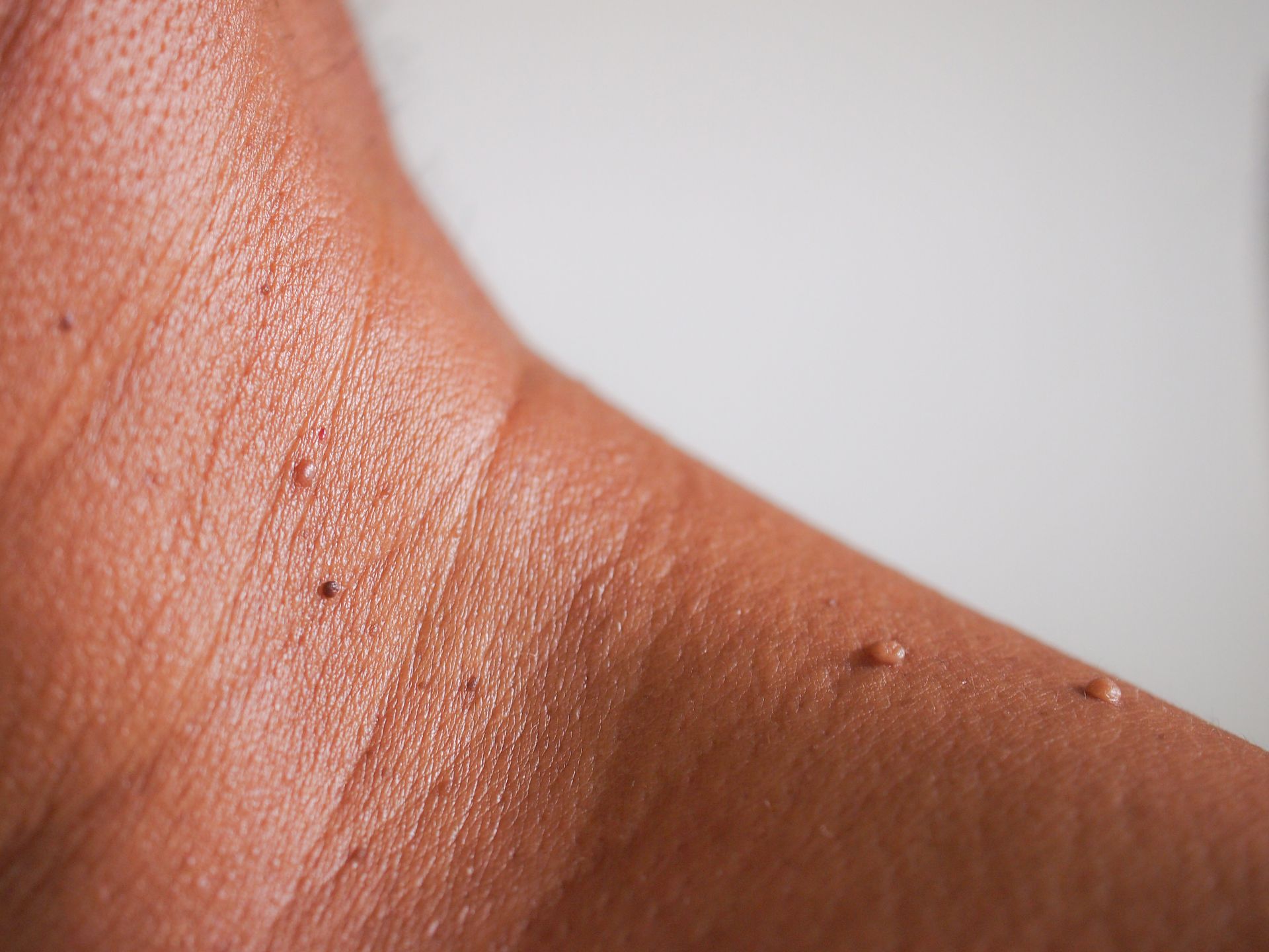 Close-up of a neck and shoulder with small skin bumps and moles
