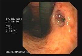 DR. ITZCOATL ANTONIO HERNÁNDEZ ESCOBEDO - ENDOSCOPIA AVANZADA DR. ITZCOATL ANTONIO HERNÁNDEZ ESCOBEDO - ENDOCOSPIA AVANZADA