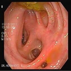 DR. ITZCOATL ANTONIO HERNÁNDEZ ESCOBEDO - ESOFAGITIS