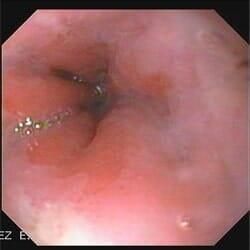 DR. ITZCOATL ANTONIO HERNÁNDEZ ESCOBEDO - ENDOSCOPÍA GASTROINTESTINAL