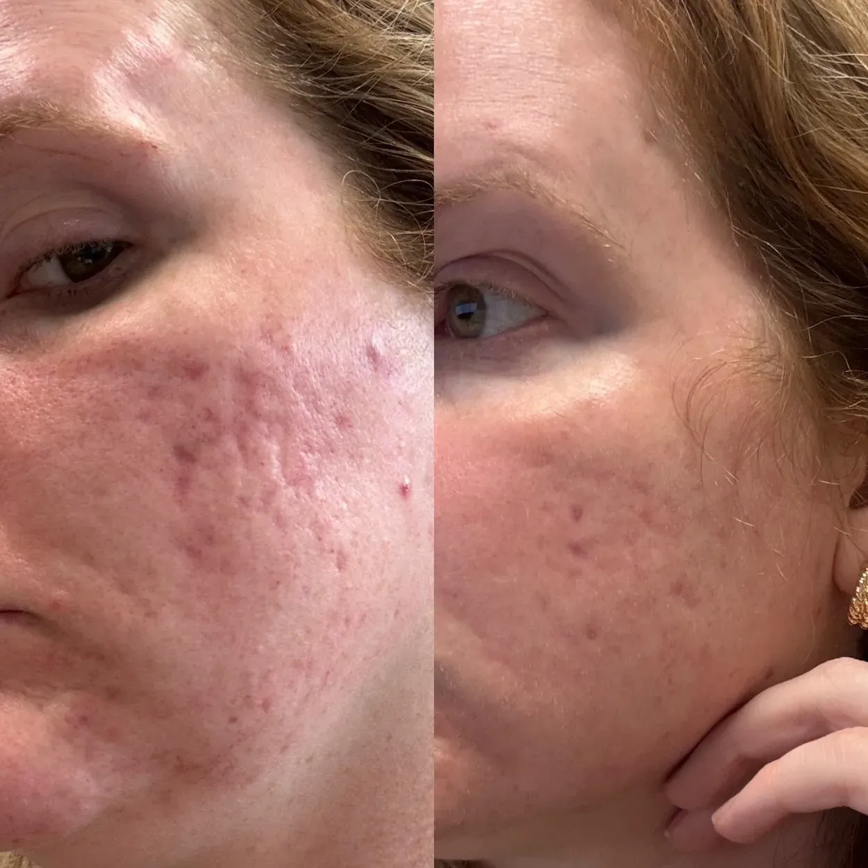 acne scar resurfacing before and after