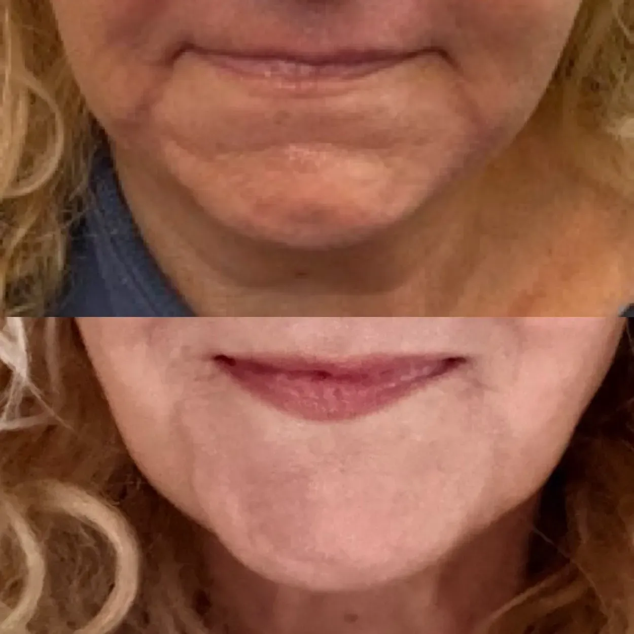 EZ Gel PRF Before and After