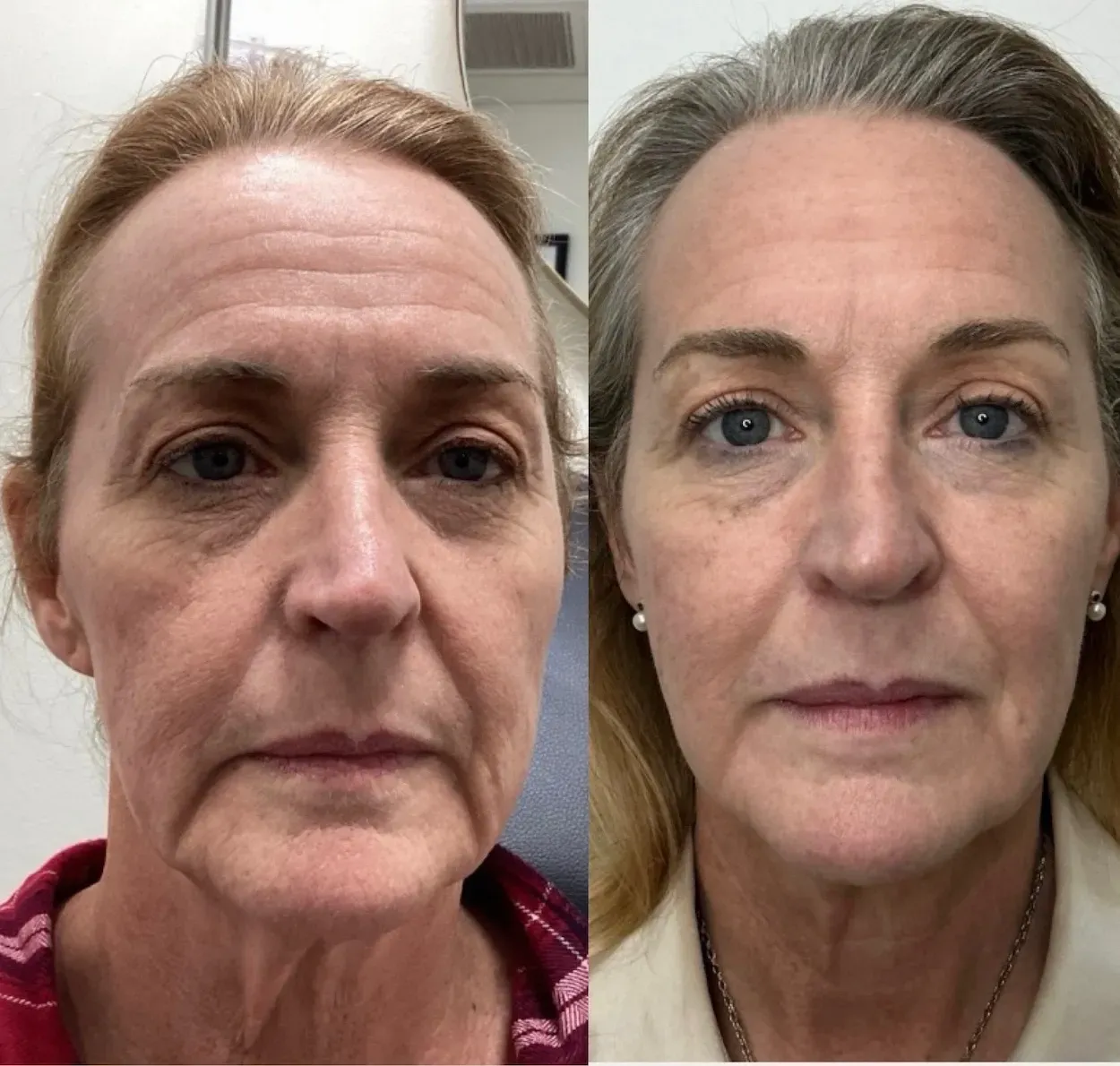 facial balancing co2 laser resurfacing before and after