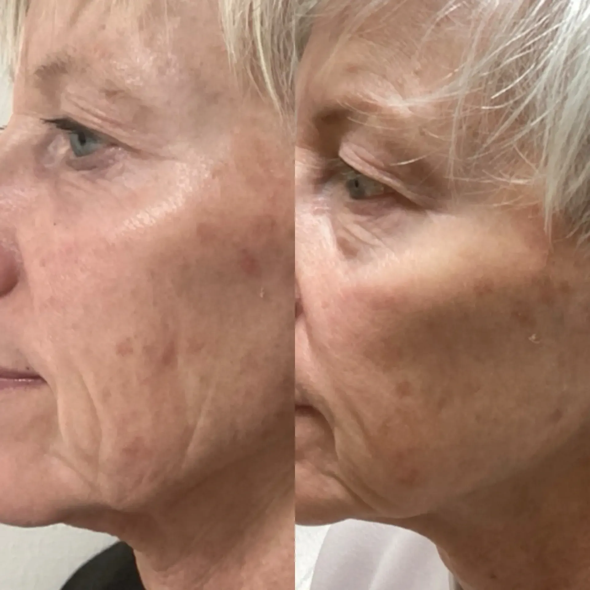 Radio-frequency Skin Tightening Before and After Right Side