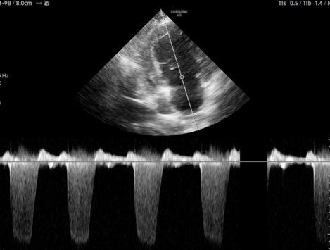 Echocardiogram with grayscale heart view and Doppler waveform tracing on black background