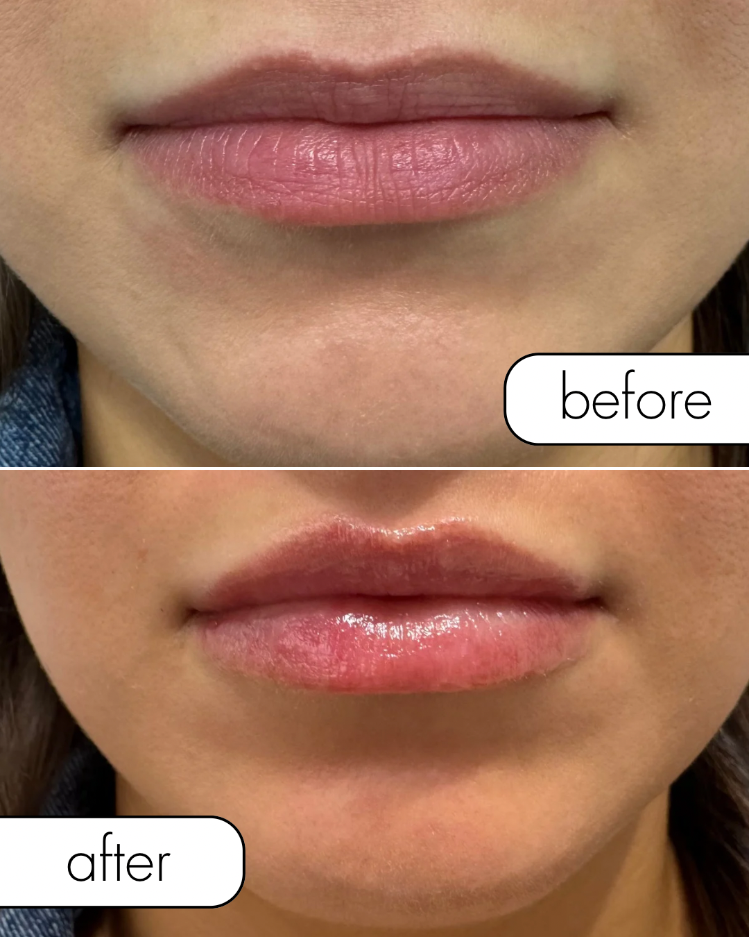 Before & After Lip Filler