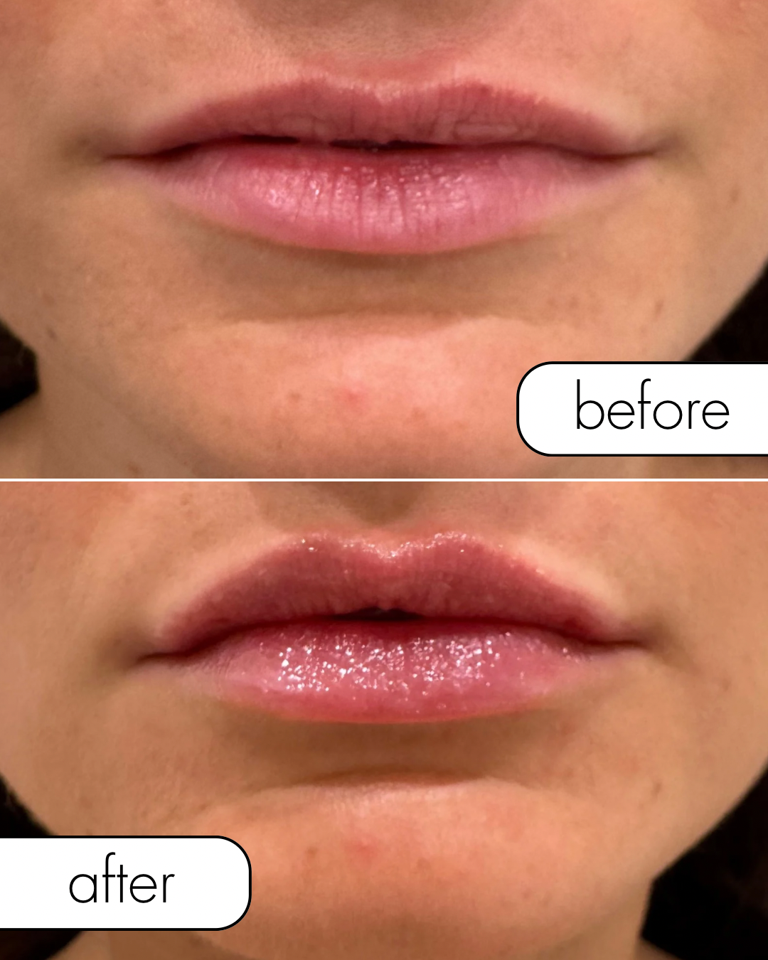 Before & After Lip Filler for First-Time Patient