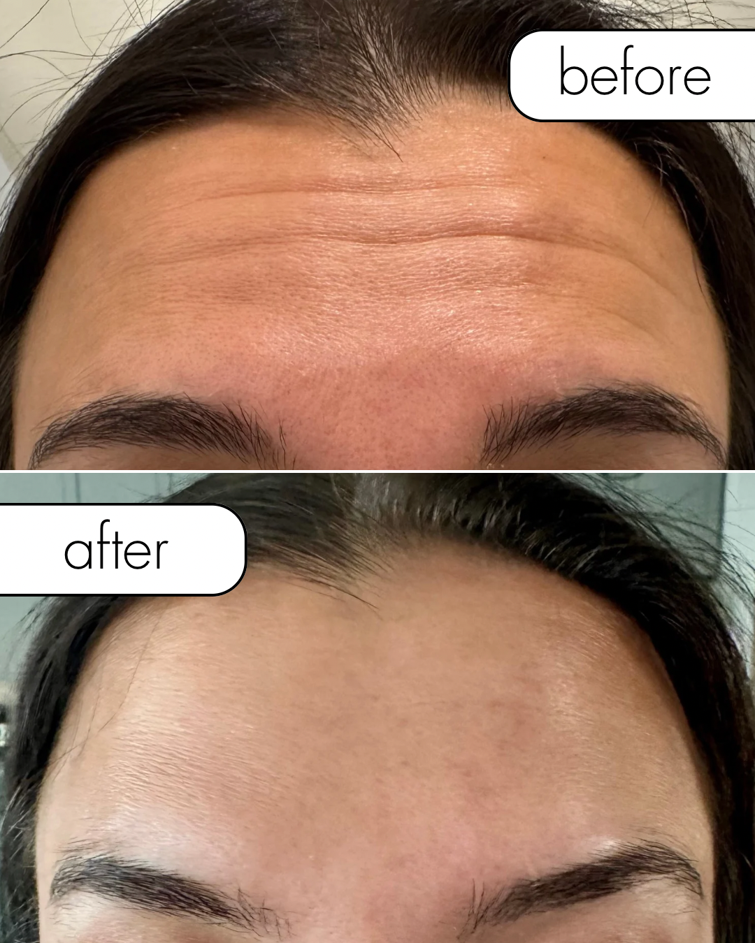 Before & After Forehead and Glabella Botox