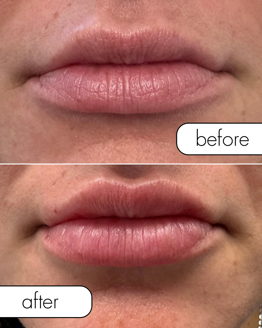 Before & After Lip Filler