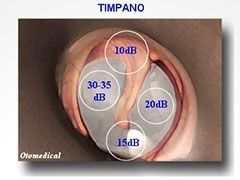 membrana timpatica