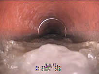 Internal view of esophagus with a metal ring visible, surrounded by a thick, white substance.