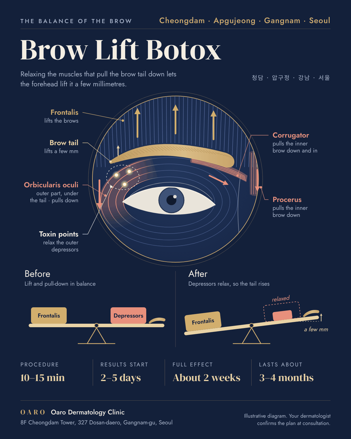 Brow Lift Botox illustrated guide, Oaro Dermatology in Cheongdam & Apgujeong, Gangnam, Seoul