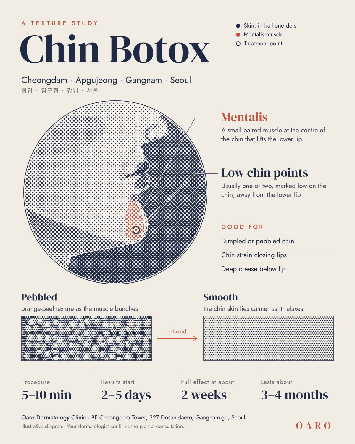Chin Botox illustrated guide, Oaro Dermatology in Cheongdam & Apgujeong, Gangnam, Seoul