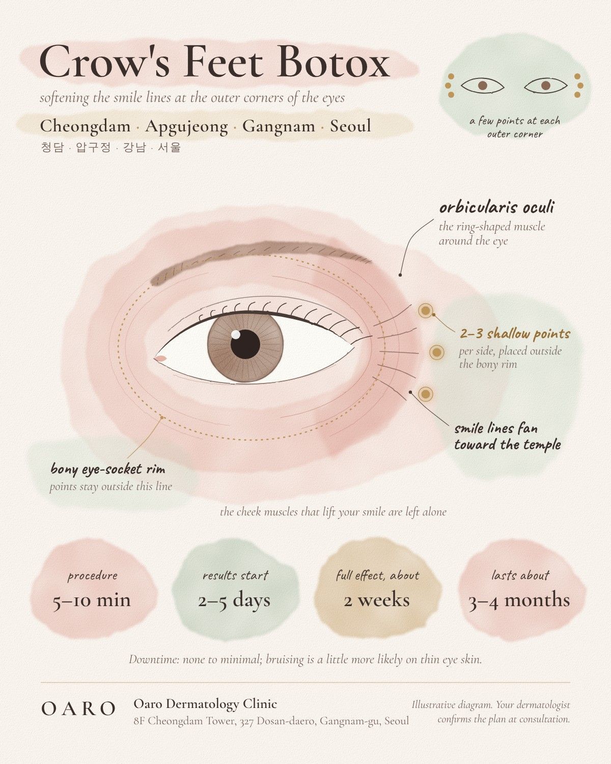 Crow's Feet Botox illustrated guide, Oaro Dermatology in Cheongdam & Apgujeong, Gangnam, Seoul