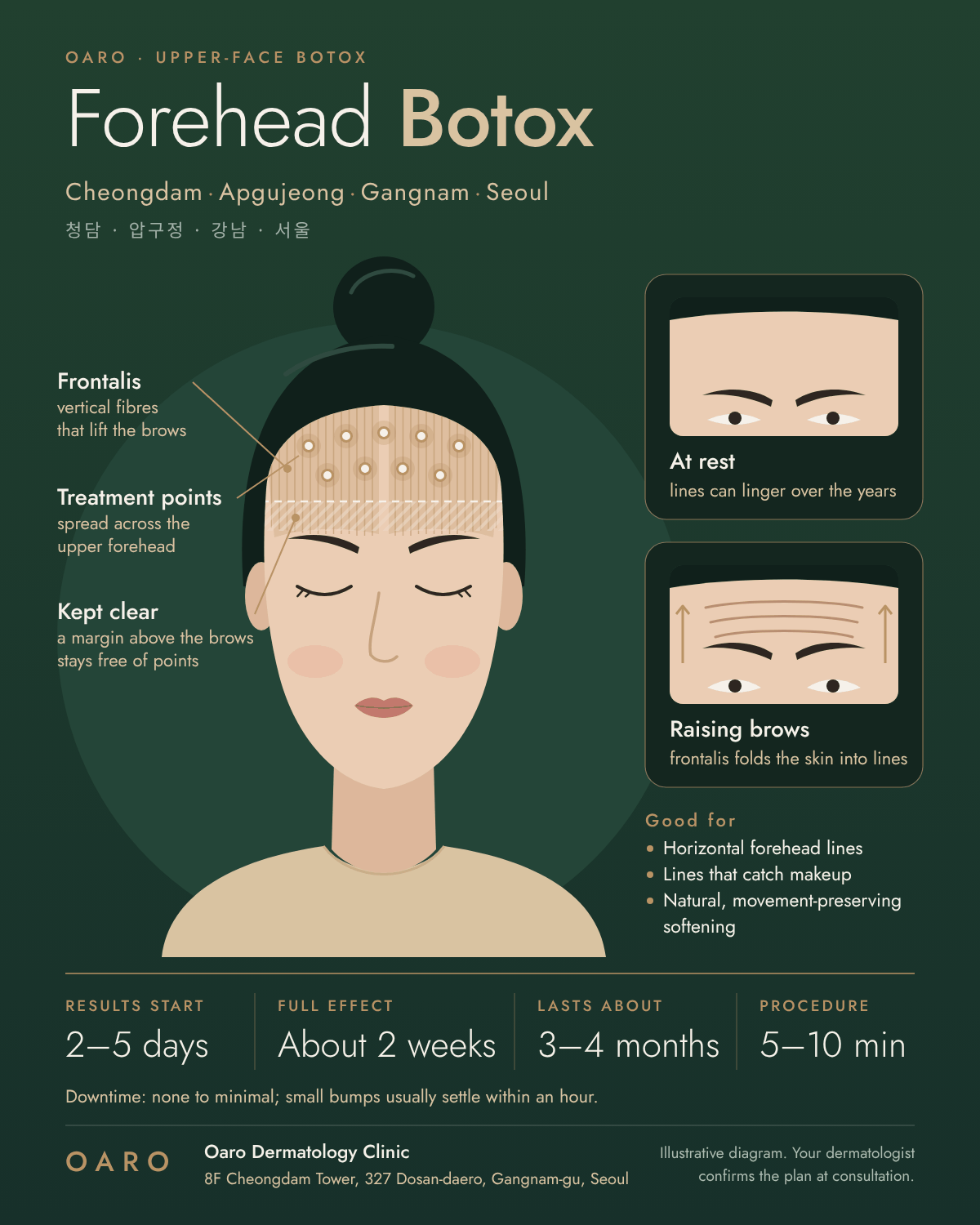 Forehead Botox illustrated guide, Oaro Dermatology in Cheongdam & Apgujeong, Gangnam, Seoul