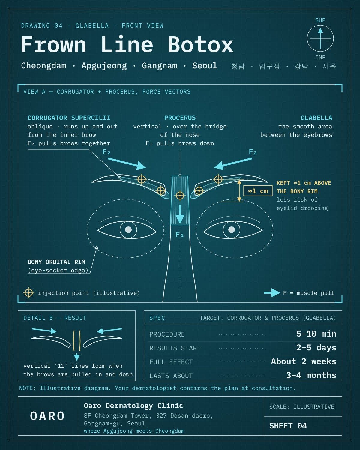Frown Line Botox illustrated guide, Oaro Dermatology in Cheongdam & Apgujeong, Gangnam, Seoul