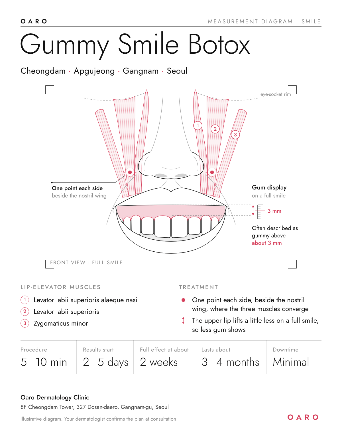 Gummy Smile Botox illustrated guide, Oaro Dermatology in Cheongdam & Apgujeong, Gangnam, Seoul