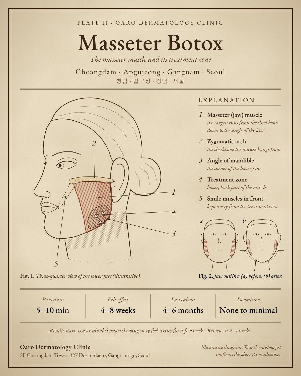 Masseter Botox illustrated guide, Oaro Dermatology in Cheongdam & Apgujeong, Gangnam, Seoul
