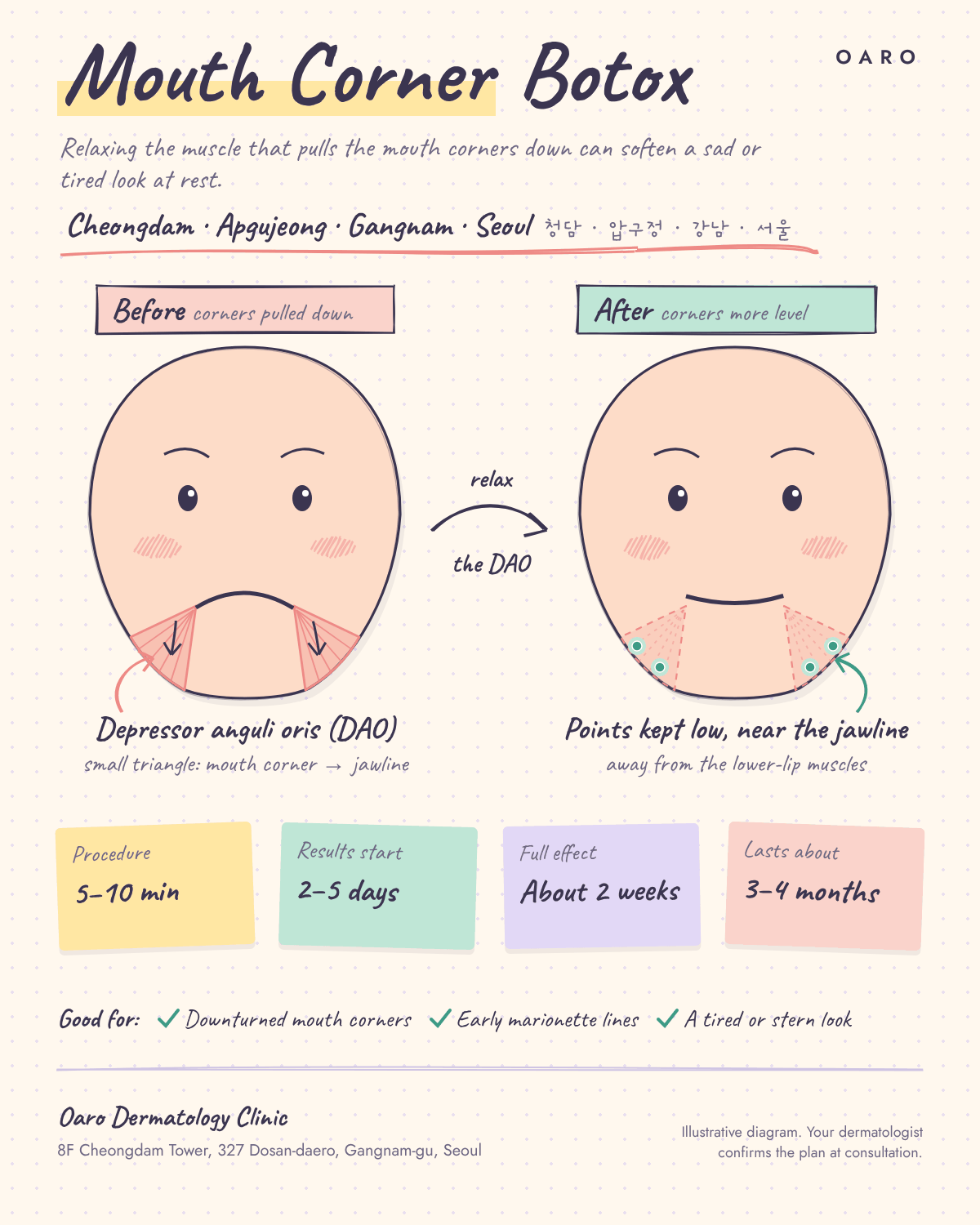 Mouth Corner Botox illustrated guide, Oaro Dermatology in Cheongdam & Apgujeong, Gangnam, Seoul