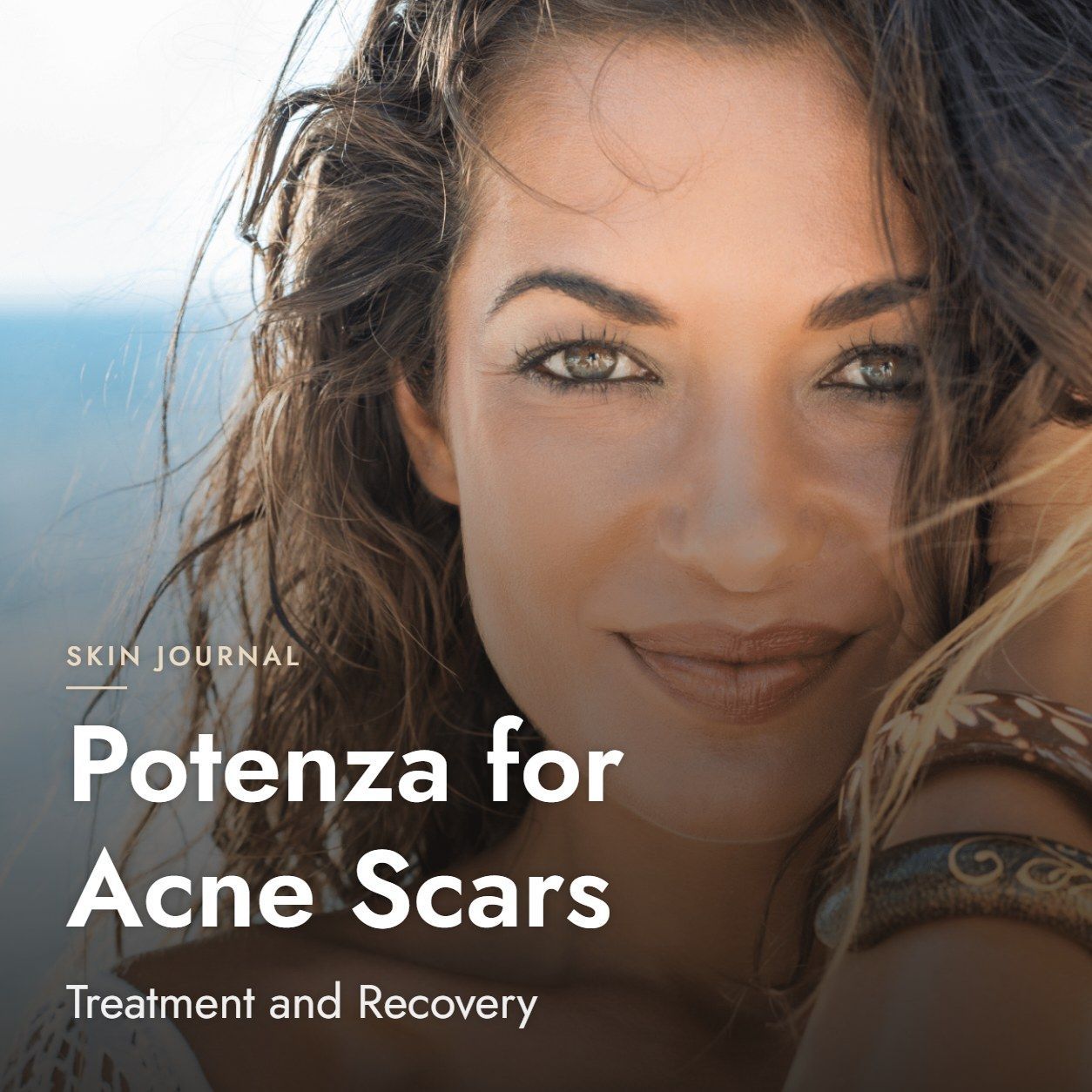 Potenza for Acne Scars: Treatment and Recovery