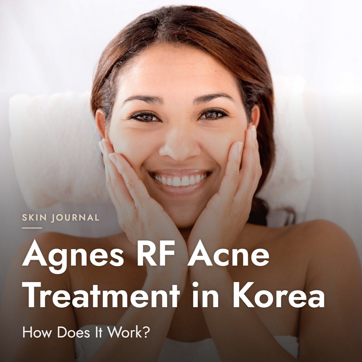 Agnes RF Acne Treatment in Korea: How Does It Work?