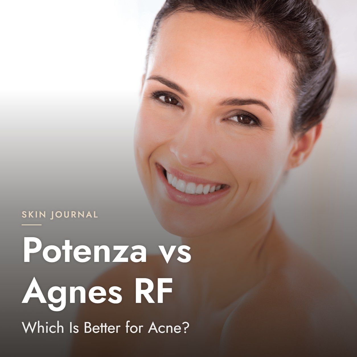 Potenza vs Agnes RF: Which Is Better for Acne?