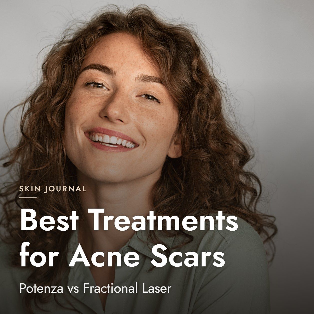 Best Treatments for Acne Scars: Potenza vs Fractional Laser