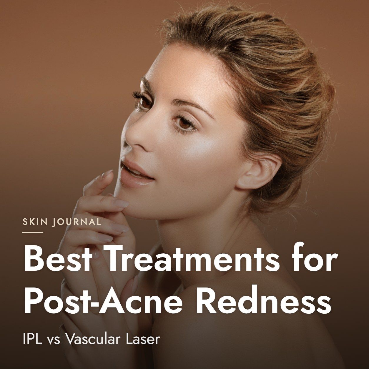 Best Treatments for Post-Acne Redness: IPL vs Vascular Laser