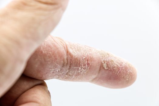 Hand Eczema