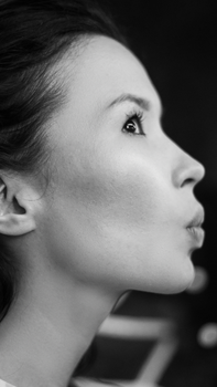 Cheek Fillers