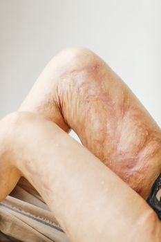 Bacterial Skin Infection